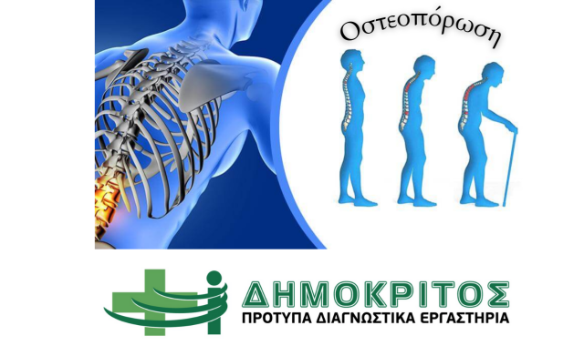 10 Πράγματα που Πρέπει να Γνωρίζετε για την Οστεοπόρωση