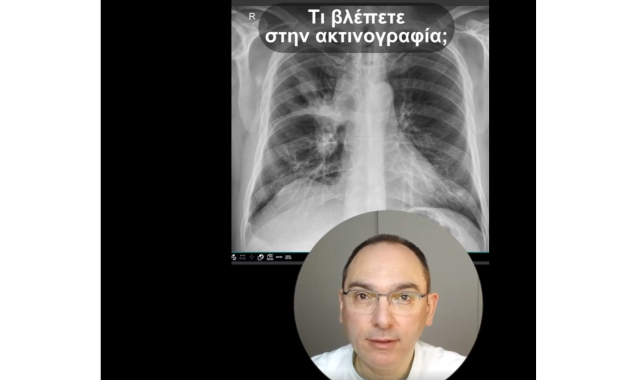 Σέρρες, Διαγνωστικά Εργαστήρια Δημόκριτος: «Σκιά» στον πνεύμονα: Τι σημαίνει πραγματικά; – Μιλά ο γιατρός, Νίκος Πανταζής (ΒΙΝΤΕΟ)